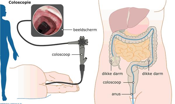 Wat is een coloscopie? Bij dit onderzoek wordt de dikke darm van binnen bekeken met een flexibele, bestuurbare slang, de endoscoop.