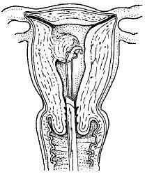 De endometriumresectie Deze ingreep vindt ook plaats via de hysteroscoop. De gynaecoloog brengt in de baarmoeder een lisje in dat elektrisch verhit wordt en dat het slijmvlies verwijdert.