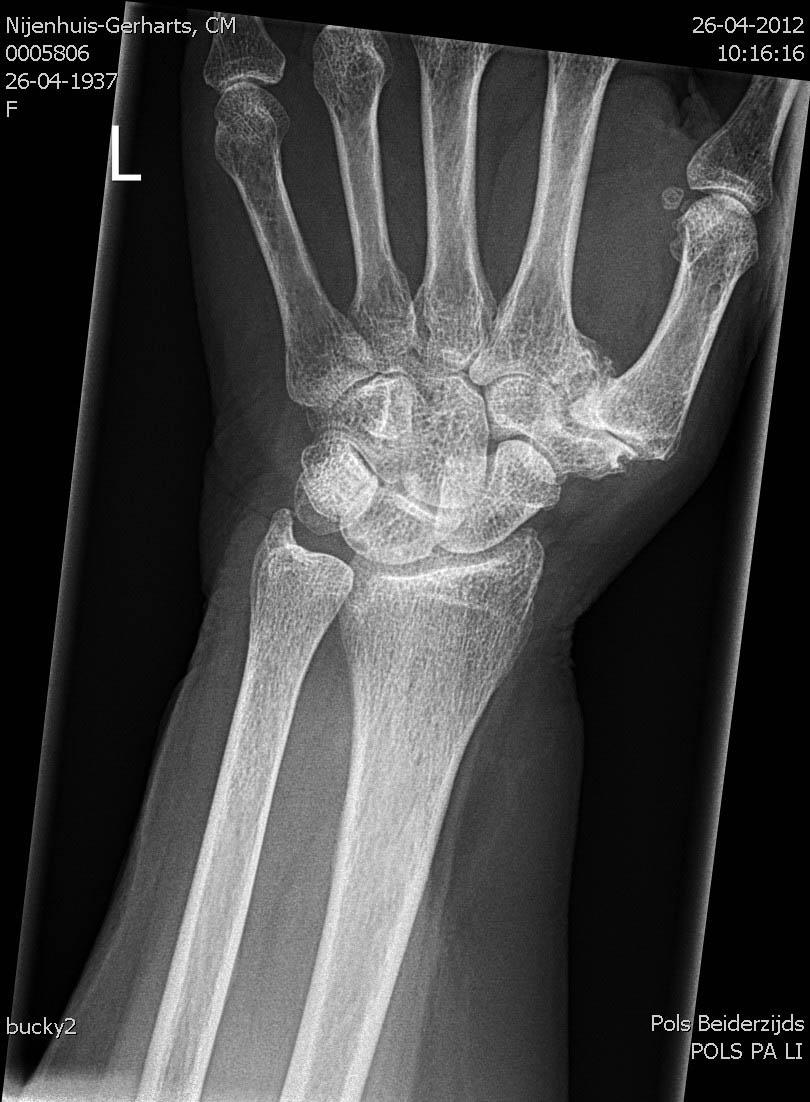 CMC1- of duimbasisartrose is een slijtage van het basisgewricht van de duim; tussen het eerste middenhandsbeentje en de pols. Het is de meest voorkomende plek waar slijtage kan optreden in de hand.