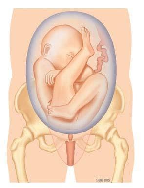 Half onvolkomen stuitligging: Eén been ligt gestrekt naar boven. Het andere been ligt gebogen naar beneden. Voetligging: De baby ligt met één of beide benen gestrekt naar beneden.