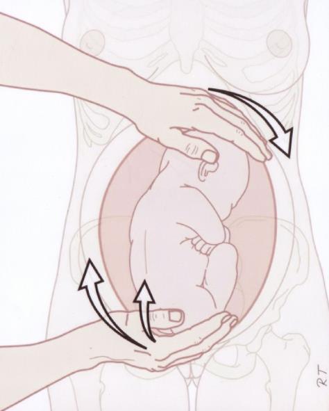 Wordt het draaien van je kindje gedaan in het ziekenhuis? Dan kunnen er medicijnen (weeënremmers) gegeven worden om de baarmoeder te laten ontspannen.