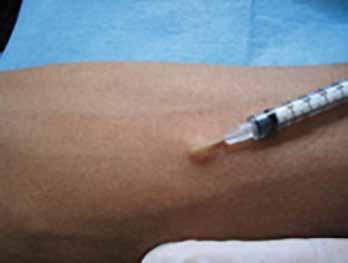 Hoofdstuk 3 - Injectiemethode Er zijn verschillende injectiemethoden te onderscheiden: intracutane/intradermale injectietechniek subcutane injectietechniek intramusculaire injectietechniek