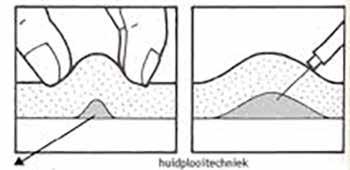 loodrechttechniek zonder en met huidplooi Huid Subcutane vetweefsel Spier Huidplooitechniek De huidplooi wordt opgenomen met twee of drie vingers; bij het opnemen van een huidplooi met vijf vingers