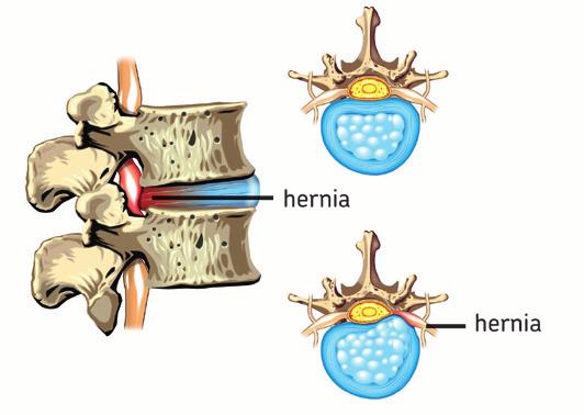 Een hernia is een uitstulping van een tussenwervelschijf.