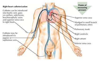 pneumothorax Centraal veneuze druk Vena femoralis Gemakkelijkst Hoog debiet (grote diameter)