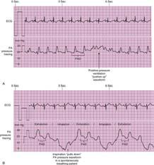 Arteria pulmonalis druk Swan Ganz katheter Eind expiratoir (intrapleurale druk 0)