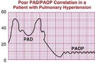 Mitralisinsufficiëntie PAD < PAOP Arteria pulmonalis druk Pulmonale hypertensie
