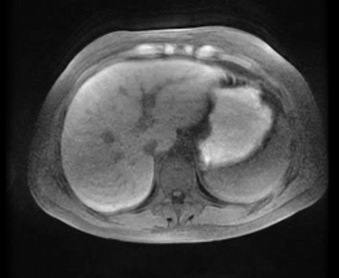 Diagnostiek Bloedonderzoek: Auto-immuun serologie en virale diagnostiek: negatief.