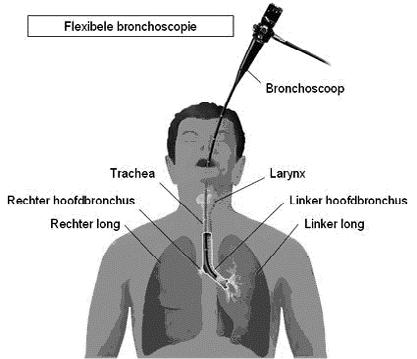 Als het nodig is, neemt de longarts kleine stukjes weefsel (biopten) af voor het onderzoek. U voelt hier niets van. U krijgt een roesje Bij dit onderzoek krijgt u een roesje, ook wel sedatie genoemd.