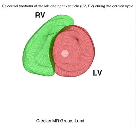 Normale rechter ventrikel PAP 25/10 Constante