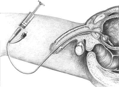 De voorbereiding op de blaasspoelingen Binnen enkele weken na de operatie (transurethrale resectie) komt u op de afdeling Urologie voor de eerste blaasspoeling.