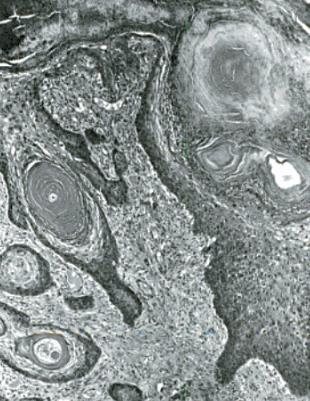 Ter hoogte van de hoornkern kan deze tumor occasioneel ook voorkomen door uitbreiding vanuit de mucosa van de sinus frontalis (Hewlett et al., 1905; Zubaidy, 1976). 2.