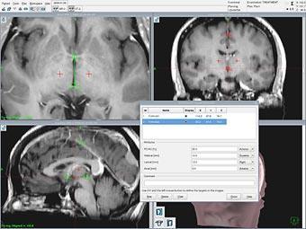 Planning Gammaplan TPS; MRI/CT
