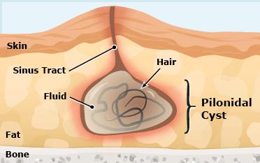 Een haarnestcyste (sacrococcygeale cyste) is een onderhuidse holte ter hoogte van de bilspleet gevuld met haren.