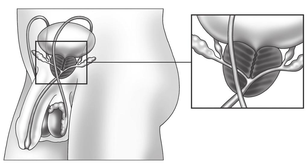 2 Door een vergroting van de prostaat (zie afbeelding 7) kunnen problemen met plassen ontstaan. Vooral bij oudere mannen komt prostaatvergroting voor.