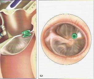 Etiologie conductief gehoorverlies -Verworven: 1) Trommelvlies: Myringitis (ontsteking van het trommelvlies), trommelvliesperforatie 2) Middenoorproblematiek: -Otitis media met effusie/ acute otitis
