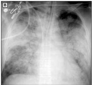 Complicaties Pneumonie Primair viraal Relatief zeldzaam, kan ernstig verlopen Niet opknappen na influenza Secundair