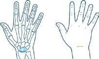 Een ganglion aan de rugzijde van de pols (cirkel linkerhand) ontstaat vaak tussen twee handwortelbeentjes (SL ligament).  Klachten Soms geeft een ganglion in de pols geen klachten.