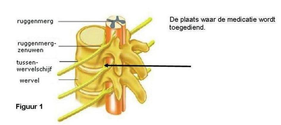 2 Beste patiënt, Je werd doorverwezen voor een behandeling van een geïrriteerde of ontstoken zenuw van het ruggenmerg ter hoogte van de lage rug of de nek.