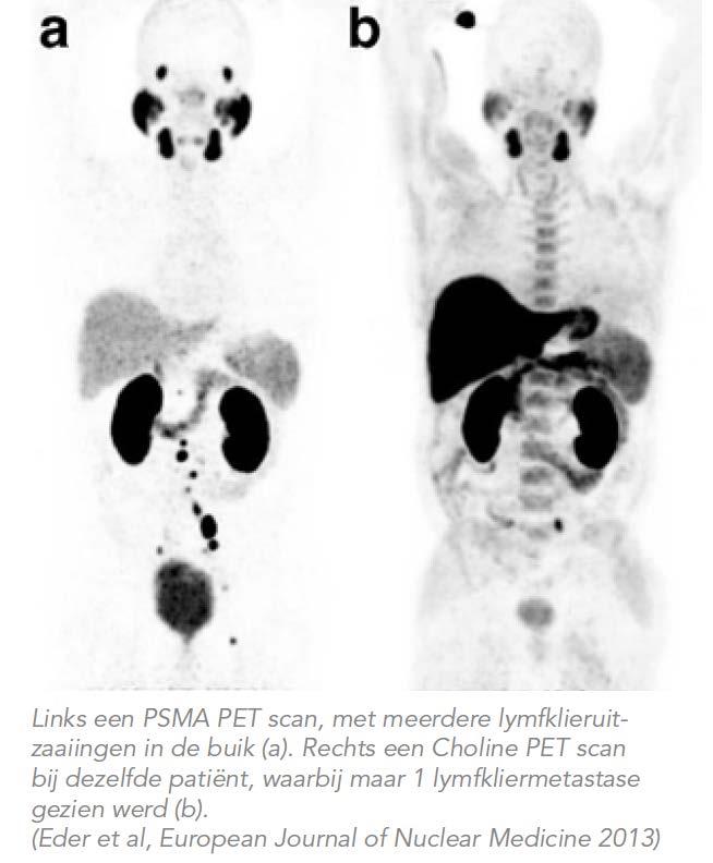 68 Ga-PSMA PET/CT in