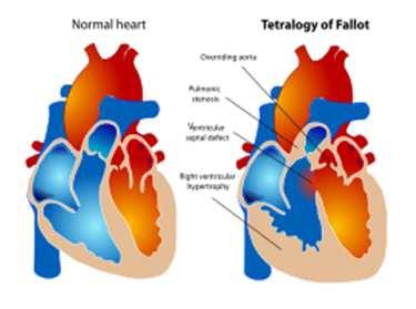 Casus 1 Man 38 jr VG: bij geboorte Tetralogie van Fallot; ventrikel septumdefect, pulmonalisstenose, overrijdende Aorta en rechter ventrikel hypertrofie.