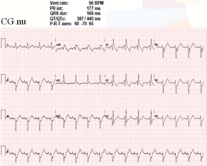 1 ECG ECG nu Sinusritme, 96/min, LAHB, incomplete RBTB, hoognormaal QTc, geen