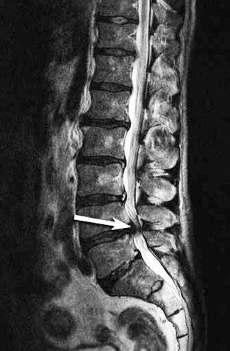 Wat is een hernia? Een hernia in de rug heet voluit Hernia Nuclei Pulposi (HNP).