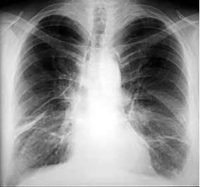 Gezondheidseffecten Asbestose = stoflongziekte Beroepsziekte: na zeer langdurige en zeer hoge