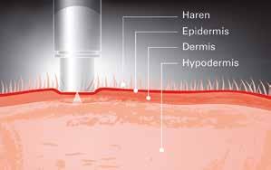 Waarom in de huid vaccineren? Waar een spier zorgt voor beweging, zorgt de huid voor bescherming. In de huid zijn dan ook volop gespecialiseerde afweercellen aanwezig (50 maal meer dan in het bloed).