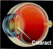 Beste patiënt Cataract is één van de belangrijkste oorzaken van gezichtsverlies bij mensen ouder dan 65 jaar. Tijdens een cataractoperatie wordt de ooglens verwijderd en vervangen door een kunstlens.