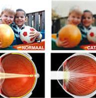 Wanneer is een ingreep nodig? Bij een beginnend cataract kan het zicht soms nog verbeterd worden met behulp van een aanpassing van de bril.