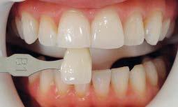 45 40 35 30 25 20 15 10 5 Hydrochloric Acid Standard Phosphoric Acid Speeksel C B&W Relative Enamel Abrasion (REA) ADA Limit General toothpaste