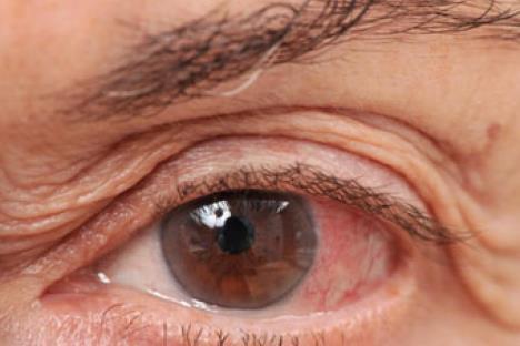 Een oogontsteking gaat vaak binnen 1 tot 2 weken vanzelf over, óók als een bacterie de oorzaak is. Antibiotica zijn meestal niet zinvol.
