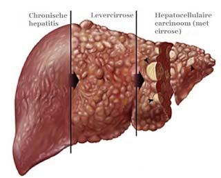 Symptomen Opslag van ijzer in de lever: Eerste aangedane orgaan Gestoorde leverwaarden Leverontsteking Kans op cirrose (verlittekening) Kans op