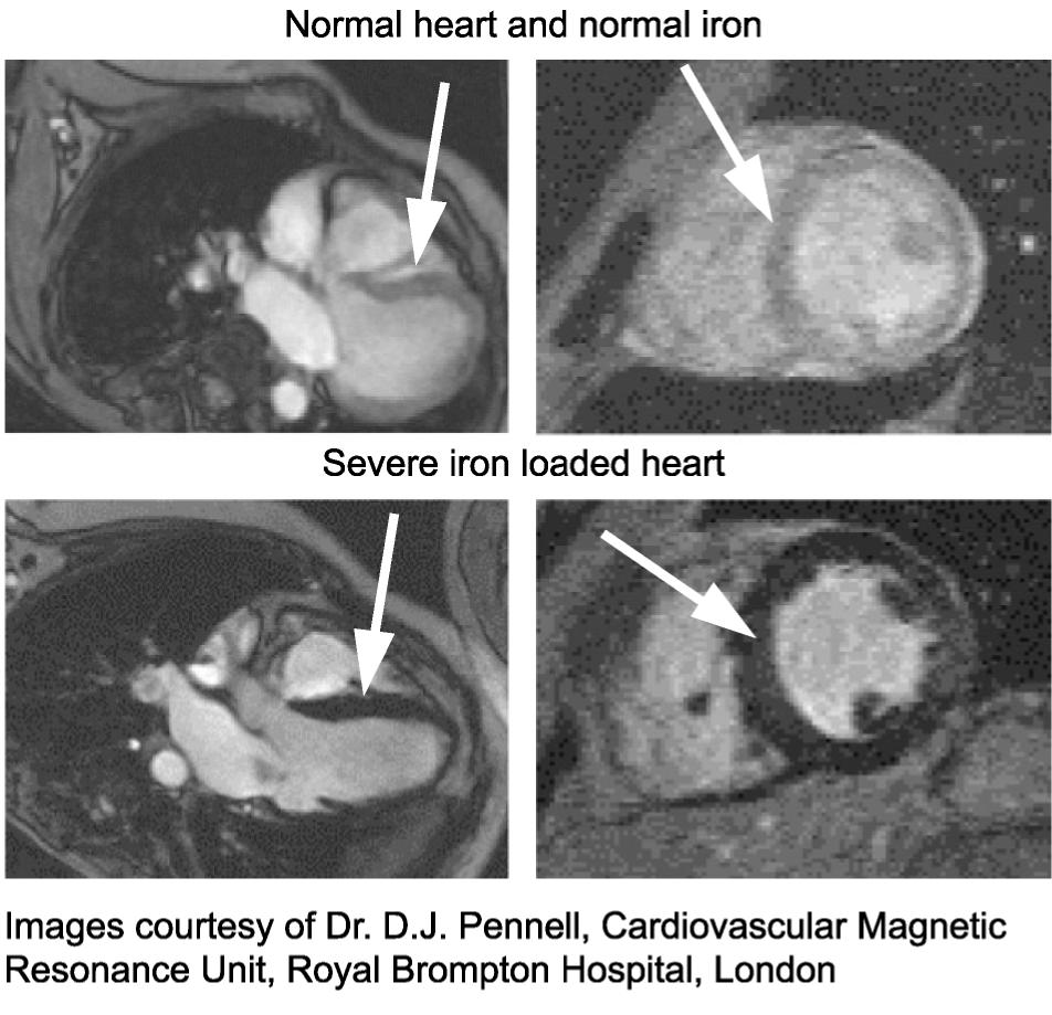 Symptomen Opslag van ijzer in hart: Hartritmestoornis Hartfalen