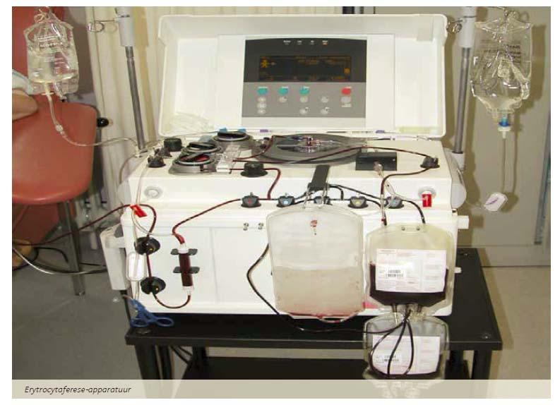 Erytrocytenaferese Geïsoleerde afname rode bloedcellen Voordelen: meer ijzerafname per keer teruggave van overige bloedbestanddelen in totaal minder