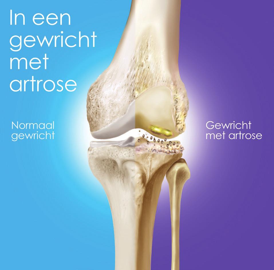 1 2 3 4 6 5 1. Normaal kraakbeen: zorgt voor een glad oppervlak, zodat botten gemakkelijk langs elkaar kunnen bewegen 2.