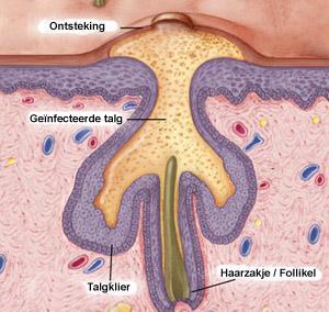 Comedonen (white head en black head) Ontstaan comedo: - Aan de binnenkant van de talgklier bevindt zich verhoornend epitheel - Er is overproductie van talg - Talg verstopt de afvoergang - Bij open
