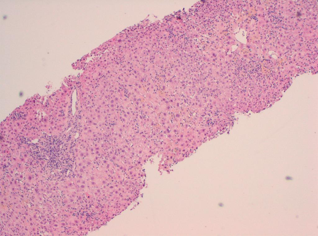 a b aggregaten van Kupfercellen centrale vene periportaal lobulair FIGUUR 1 Histologische coupe van een leverbiopt van patiënt A.