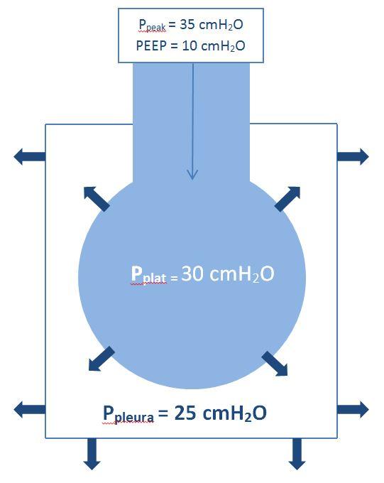 plat ) - -6 (P pl ) = 28cmH 2 O P tp = 30(P plat ) 25 (P pl