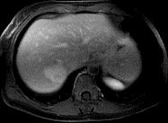 on delayed-phase imaging EASL