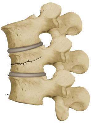 Zojuist heeft u een zogenoemde hyperextensie orthese (Jewett brace) aangemeten gekregen.