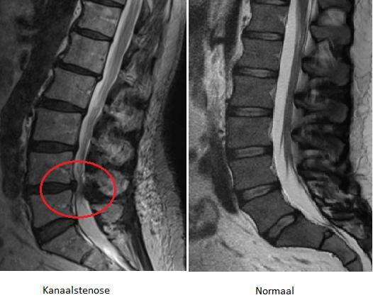 Klachten en verschijnselen De klachten die ontstaan bij een kanaalstenose zijn met name rug- en beenpijn.
