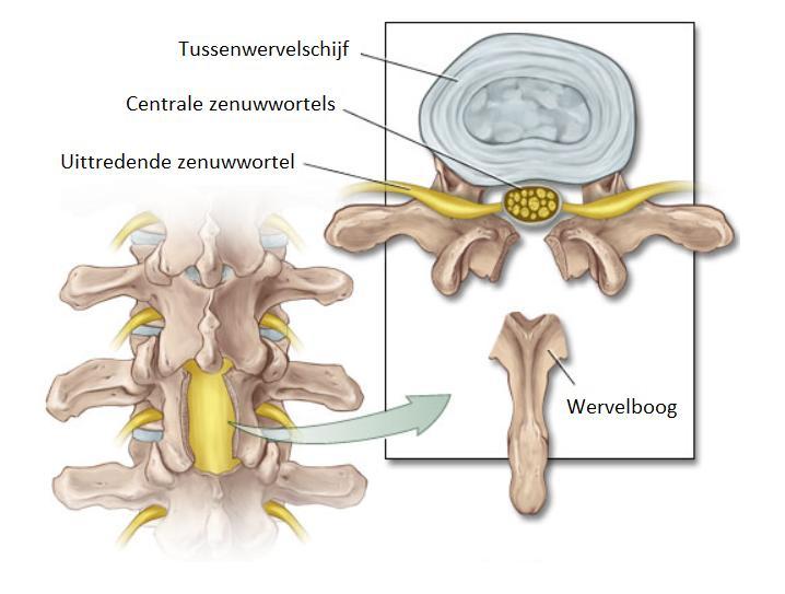 Fig. 6 Grafische weergave operatieve decompressie bij kanaalstenose Fig.