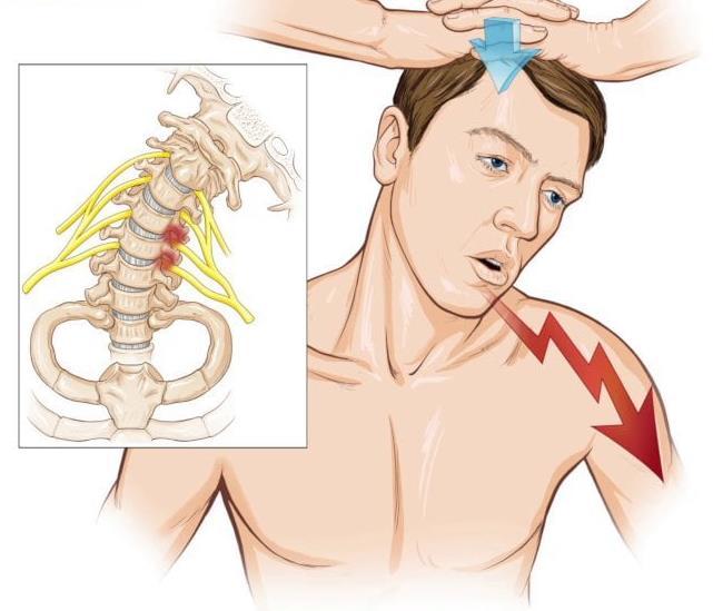 Cervicobrachialgie: test van Spurling Gebeurt om een zenuwcompressie vast te stellen De onderzoeker: Voert axiale druk uit Legt nek in