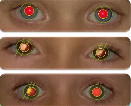 vanaf het netvlies in beide ogen te zien. De app analyseert de rode pupillen en maakt een schatting van mogelijke refractieafwijkingen.