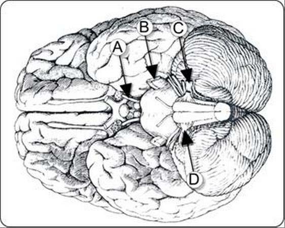 pagina 18 van 28 arteria cerebri media arteria cerebri posterior arteria communicans anterior arteria cerebri anterior arteria cerebelli superior arteria communicans posterior ai of bb [Originele