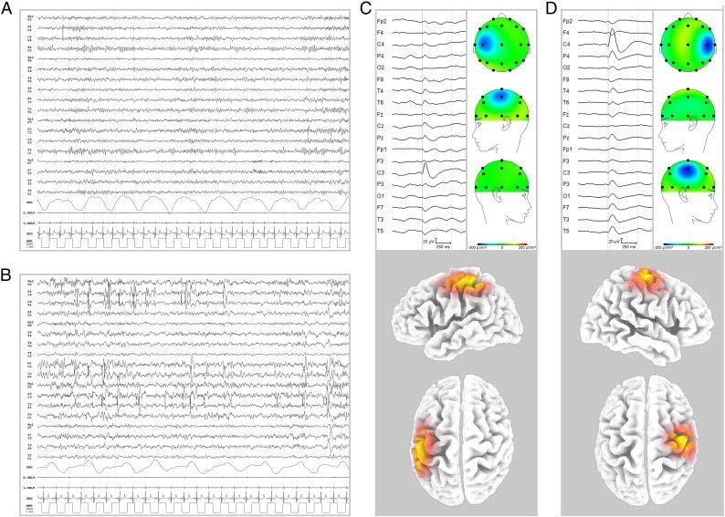 Wanneer is er sprake van resolved epilepsie?