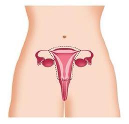 Littekens na een baarmoederverwijdering door middel van een kijkbuisoperatie Figuur 3a De baarmoederverwijdering zelf Welke methode?