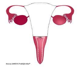 Nadelen van het verwijderen van de baarmoederhals: er is een zeer kleine kans op beschadiging van de ureter (de urineleider van de nier die naar de blaas loopt, vlak naast de baarmoederhals).